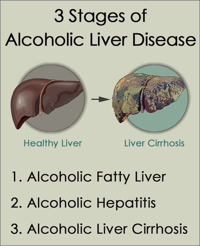 3 stages of alcoholic liver disease