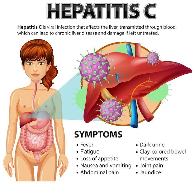 hepatitis c